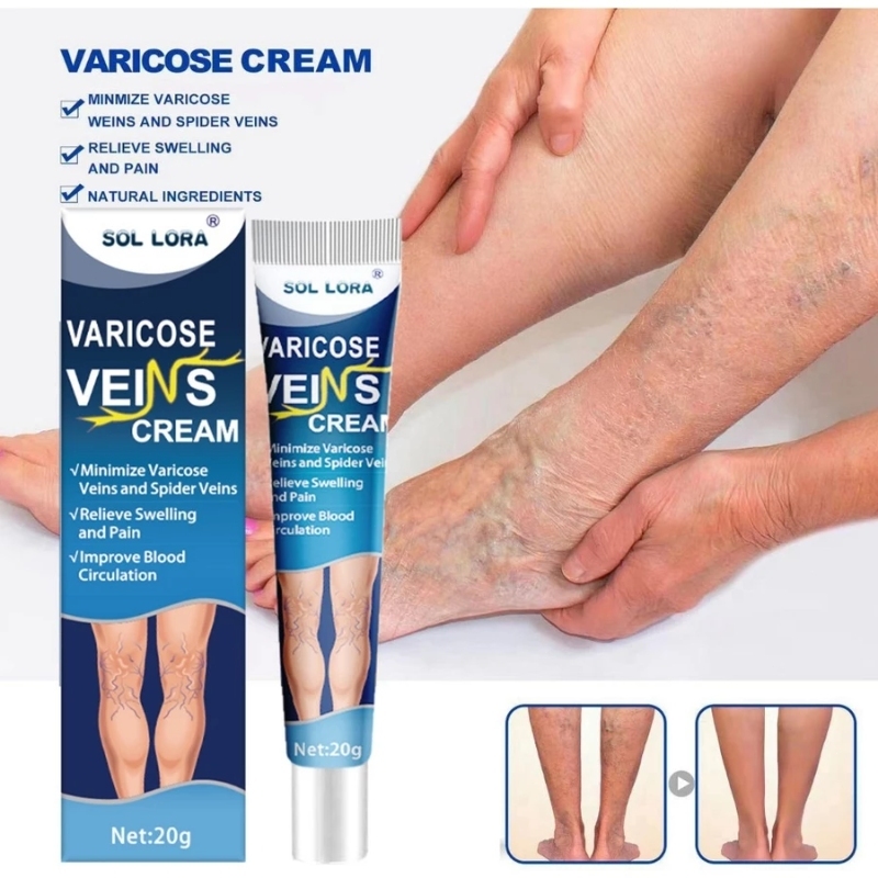 [Shipping from Singapore] Vein Cream 20g varicose veins cream varicose ...