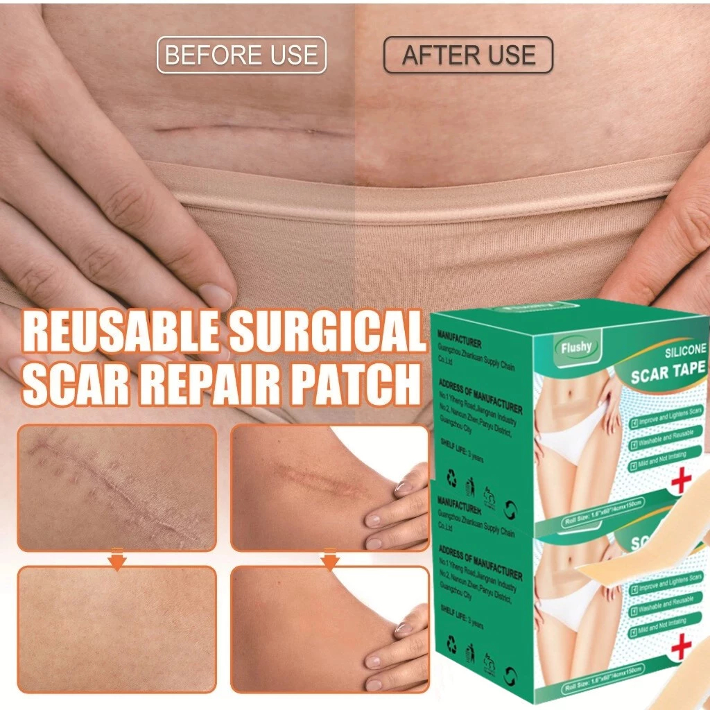 ⭐Closeout⭐Silicone Scar Patches Surgical Scar Removal Cesarean Scar ...