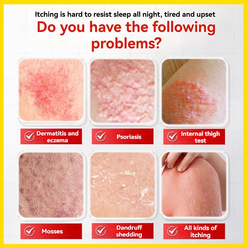 Eczema Cream psoriasis cream 20g anti itch cream Japan Sulfur Eczema ...