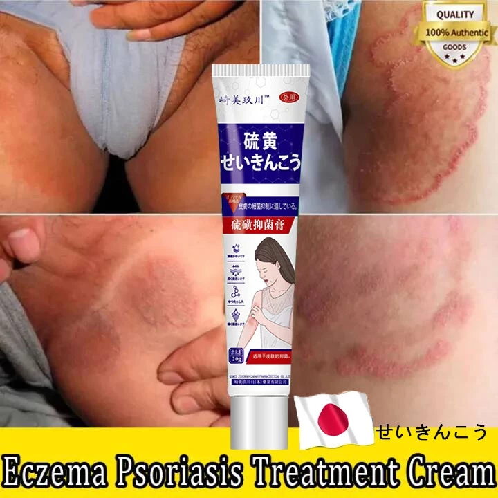 Eczema anti itch cream Japan cream for itchy skin psoriasis cream ...