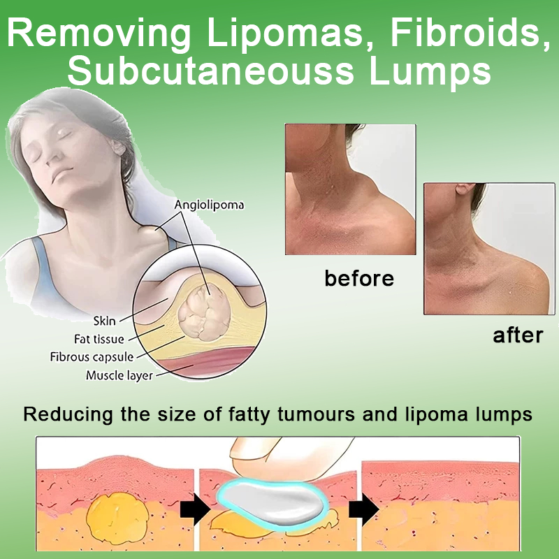 Lipoma Removal Cream 20g Removing Lumps In The Body Lymph Multiple ...