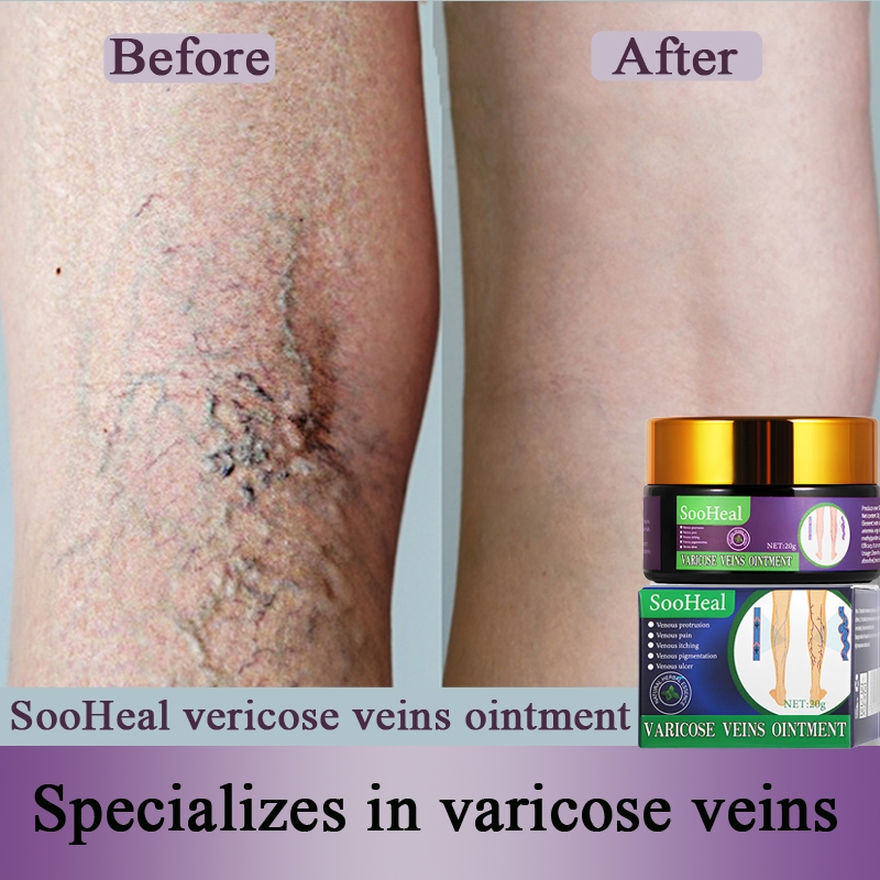 Varicose Vein Cream 20g Effectively removes varicose veins and relieves ...