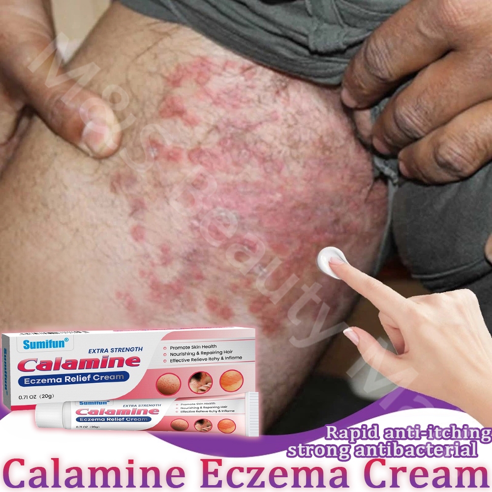 Calamine eczema cream 20g is suitable for skin itching, allergies ...
