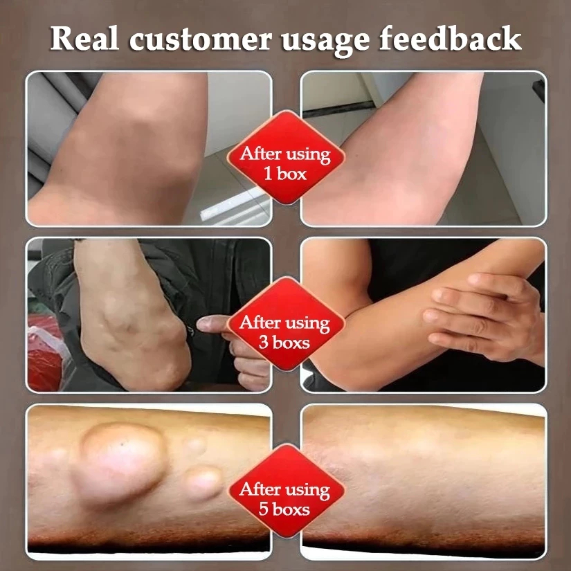 Lipoma Removal Patches 12pcs/box Lipoma Patch Treat Tumor Skin Swelling ...