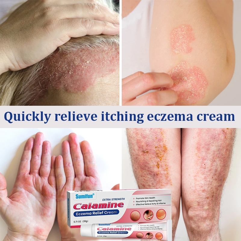 Eczema anti-itch cream, herbal antibacterial ointment, anti-acne, acne ...