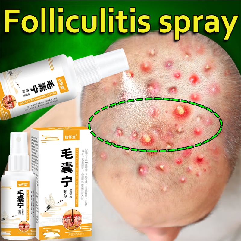 Seborrheic dermatitis spray folliculitis spray 30ml scalp eczema ...