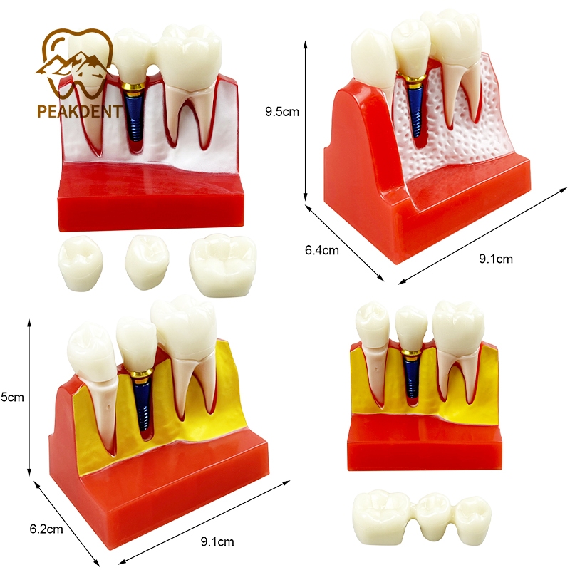 Dental Implant Model Teeth Model Dental Teaching Model Removable Tooth ...