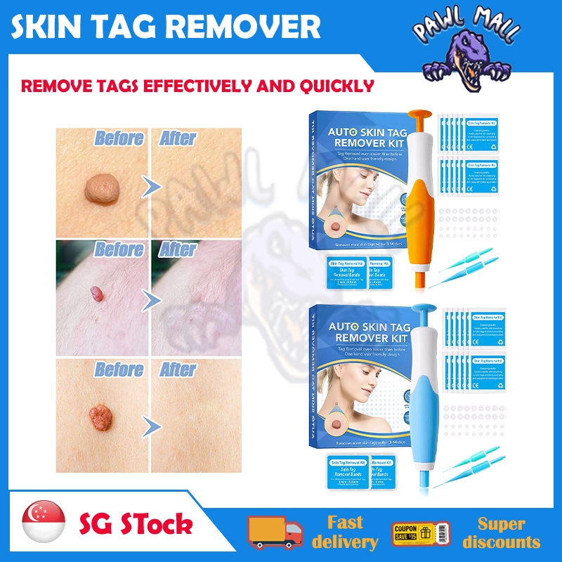 Skin Tag Remover Kit Automatic Skin Tag Remover 2-9mm Skin Tags Wart ...