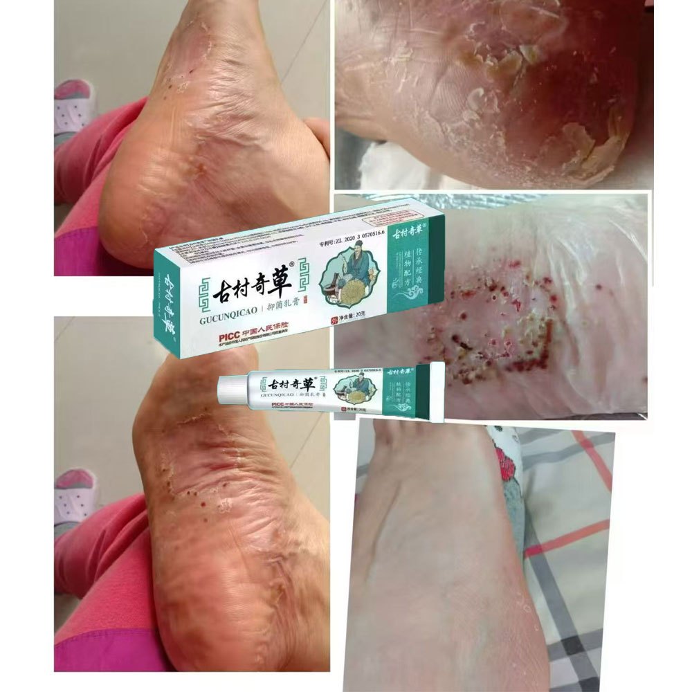 Topical skin ointment, Itching,Skin fungal infection, Various skin, 7 ...