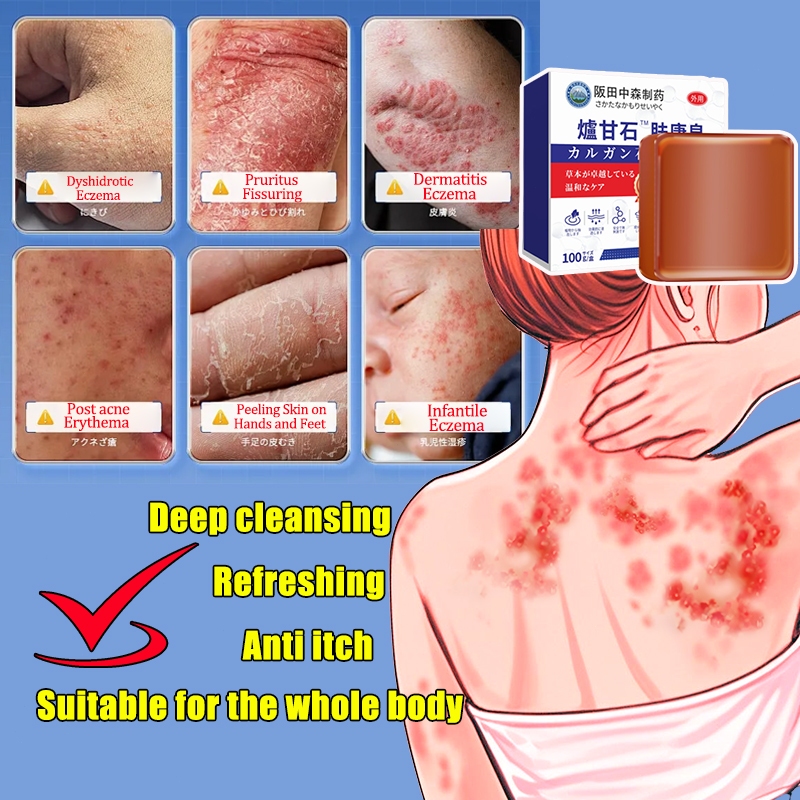 Calamine Soap 100g Suitable all skin Great for Eczema Rashes Itch ...