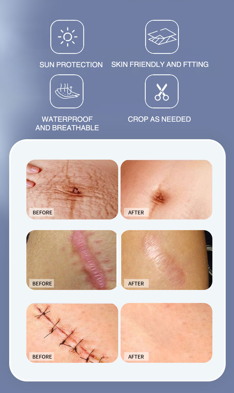 Scar removal patch 4*50cm scar removal strips to remove old scars and ...