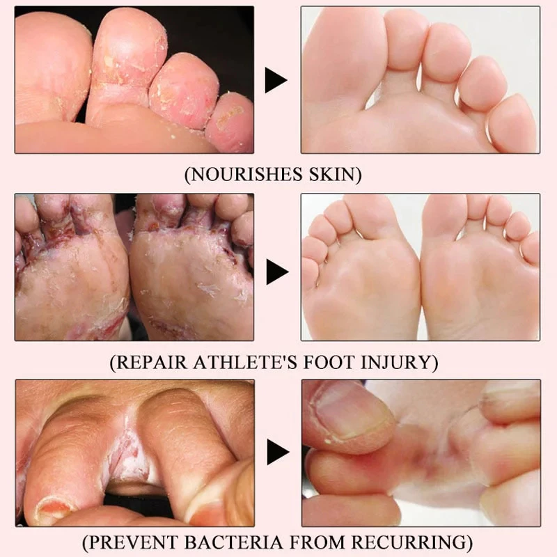 Anti Fungal Foot Spray 30ml 腳氣噴劑 Athlete Foot Spray Itchy Feet Peeling ...