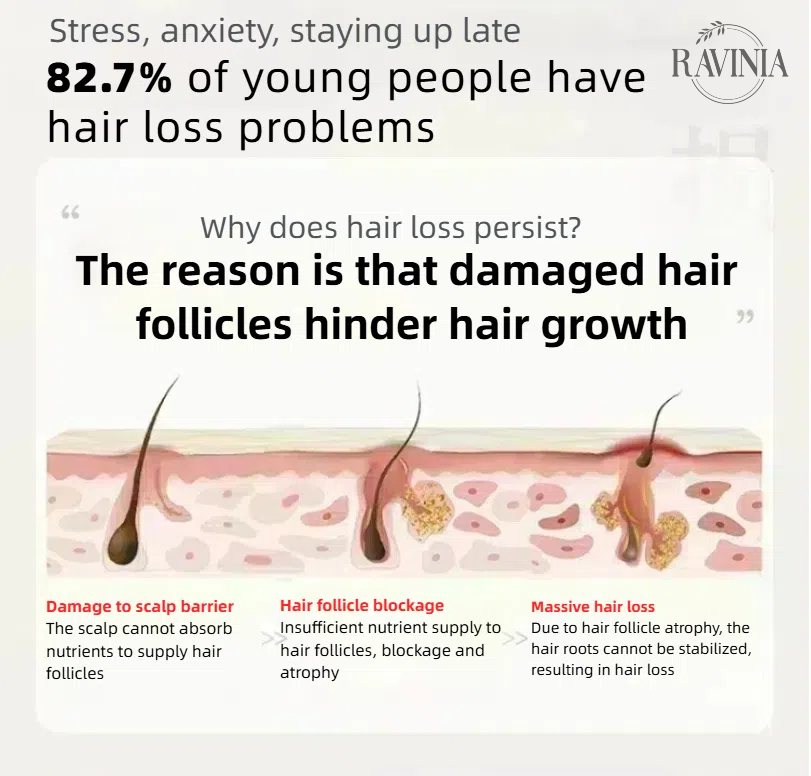 RAVINIA Hair growth spray 60ml Anti hair loss Natural plant essence ...