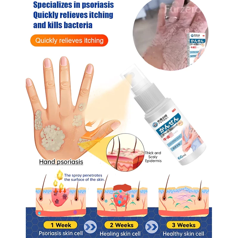 Psoriasis Spray Eczema anti itch Spray psoriasis remission dermatitis ...