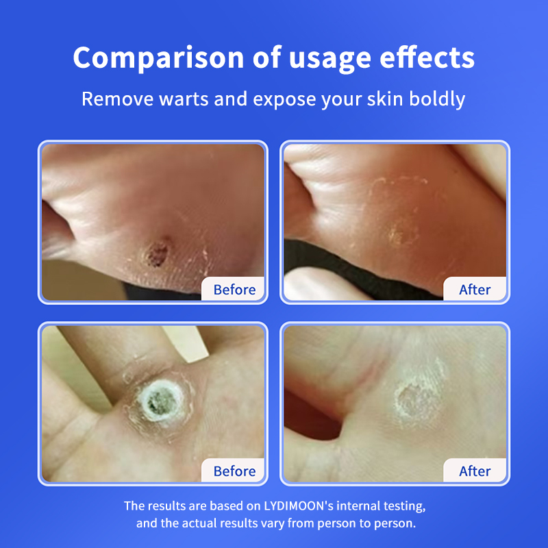 wart removal cream 20g Skin Tag Remover vulvar condyloma acuminatum ...