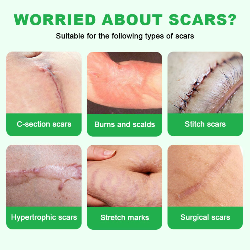 Scar Removal Cream-Fade Scars-Inhibit Hyperplasia-Relieve Itching for ...
