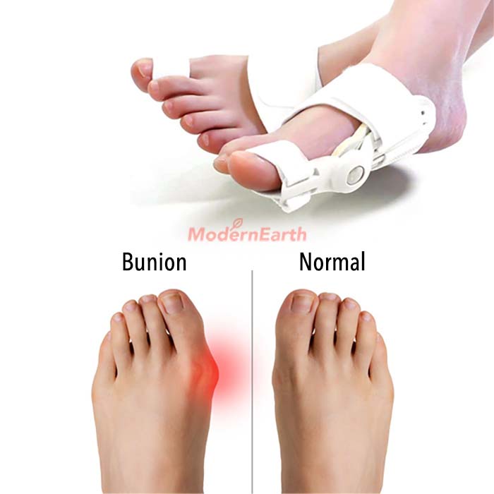 [SG Stock] Bunion Corrector, Bunion Splint Big Toe Corrector, Bunion ...