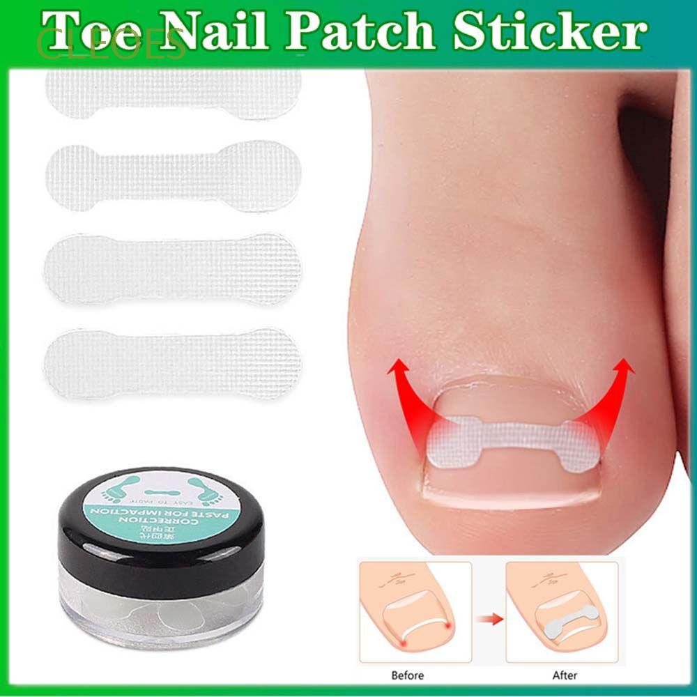 CLEOES Useful Ingrown Toenails Stickers Portable Correction Sticker