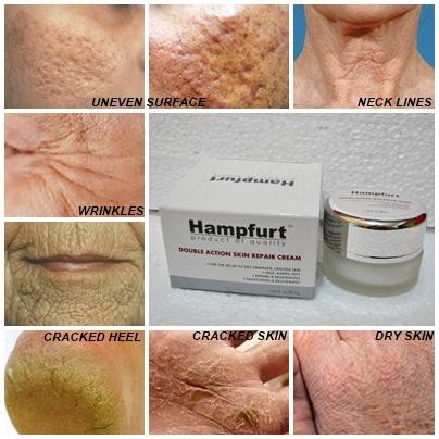 Hampfurt - DOUBLE ACTION SKIN REPAIR CREAM (FAST & EFFECTIVE) | Shopee ...