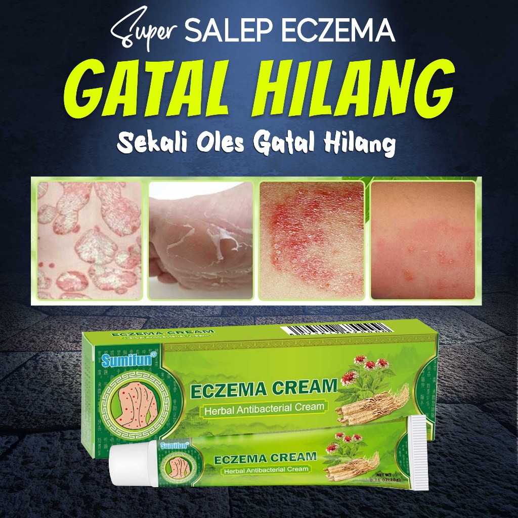 Eczema Anti Itching Ointment Eczema Skin Ointment Anti Bacterial ...