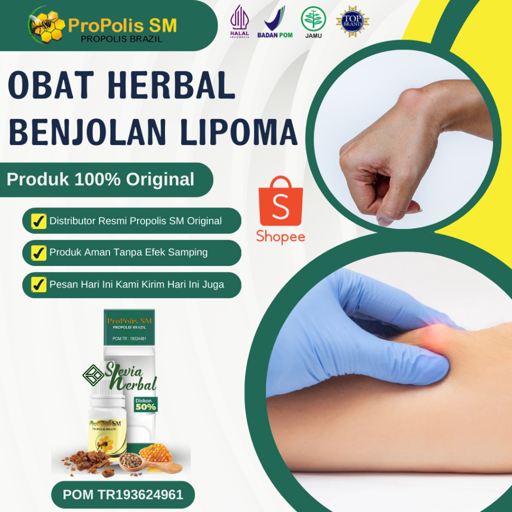 Lipoma Lumps Medicine - Lymph Nodes - Lumps in the Neck | Propolis SM ...