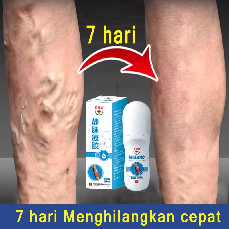 Varicose Veins Medicine For Varicose Veins In The Legs And Calf 50ml ...