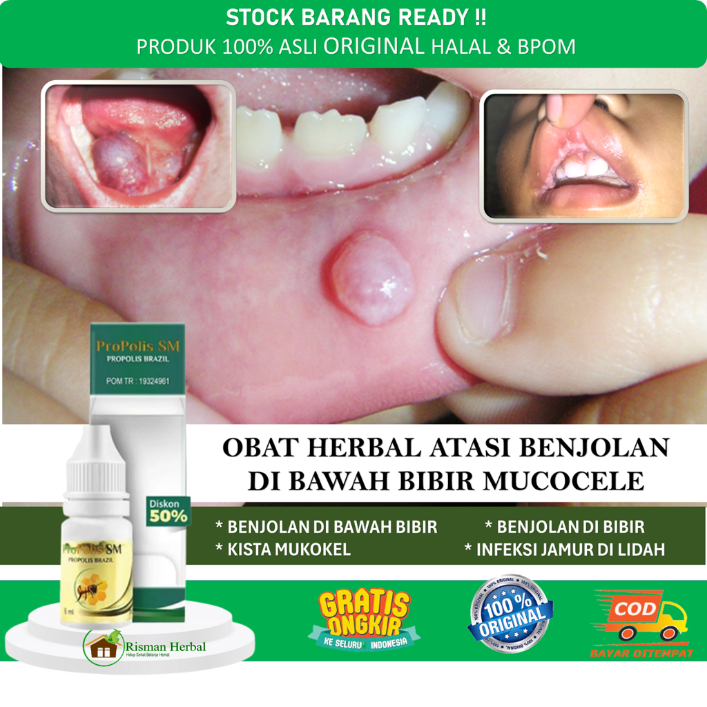 PUTIH Medicine For Removing Bad Breath, Rot, White Spots On The Tongue ...