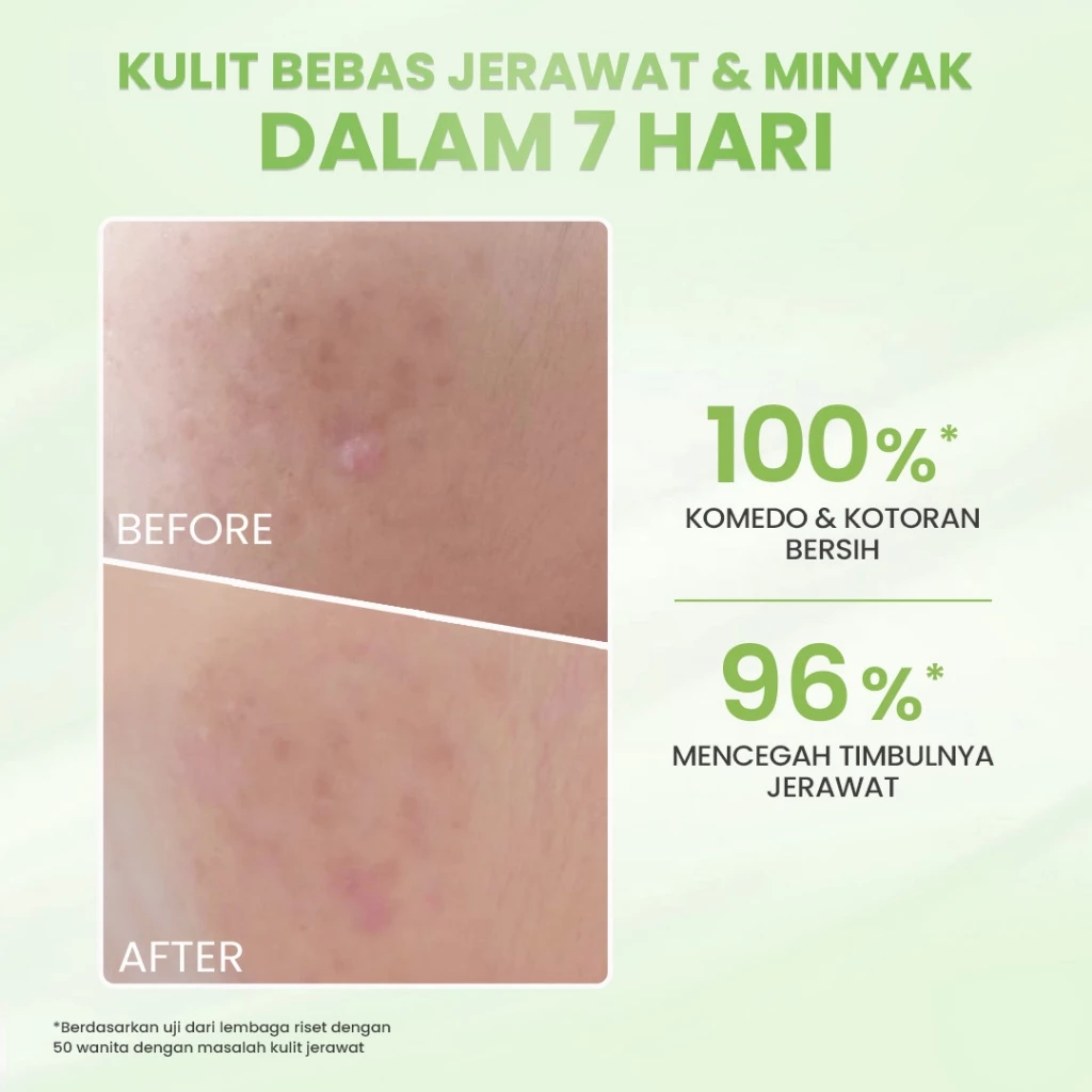 Hanasui Acne Expert Gentle Cleanser Sabun Busa Lembut Mengurangi Jerawat Tanpa Rasa Ketarik - Salicylic Acid Centella Panthenol - Gambar 3