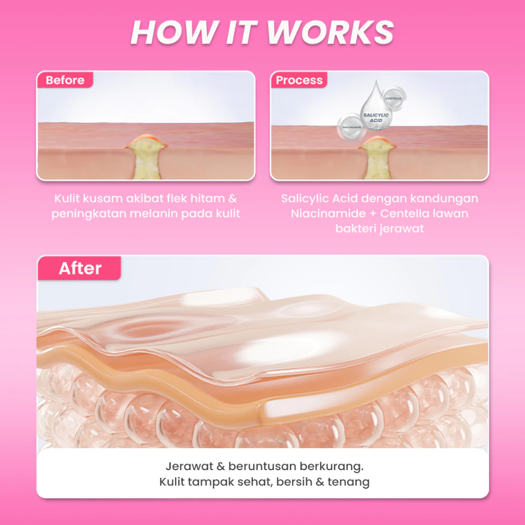 Hanasui Anti Acne Serum - Jerawat & Beruntusan Menenangkan dengan Centella Asiatica Salicylic Acid & Niacinamide - Gambar 3