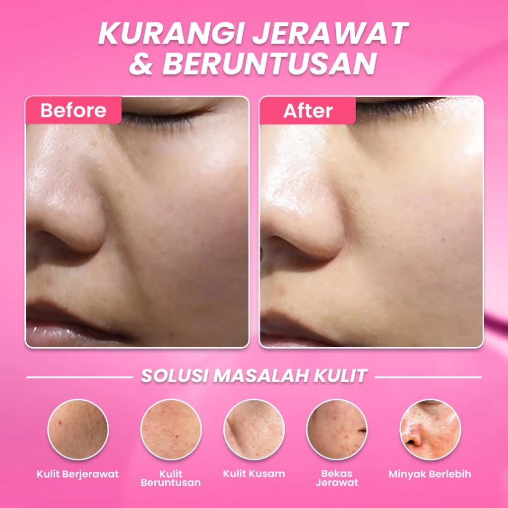 Hanasui Anti Acne Serum - Jerawat & Beruntusan Menenangkan dengan Centella Asiatica Salicylic Acid & Niacinamide - Gambar 2