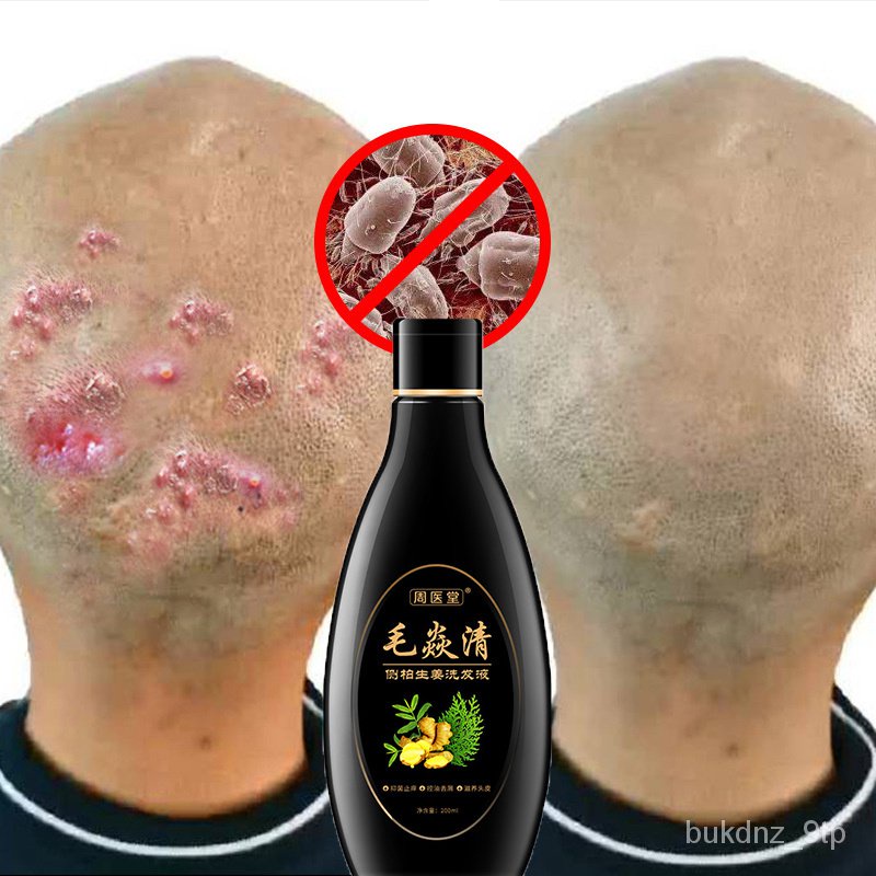 Scalp Hair Follicle Shampoo Antibacterial Antiitching Mites Oil