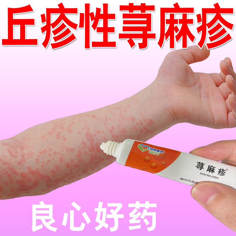 Nettle Rash Rapid Chronic Hypnotic Wind Group Scratch Special Cream