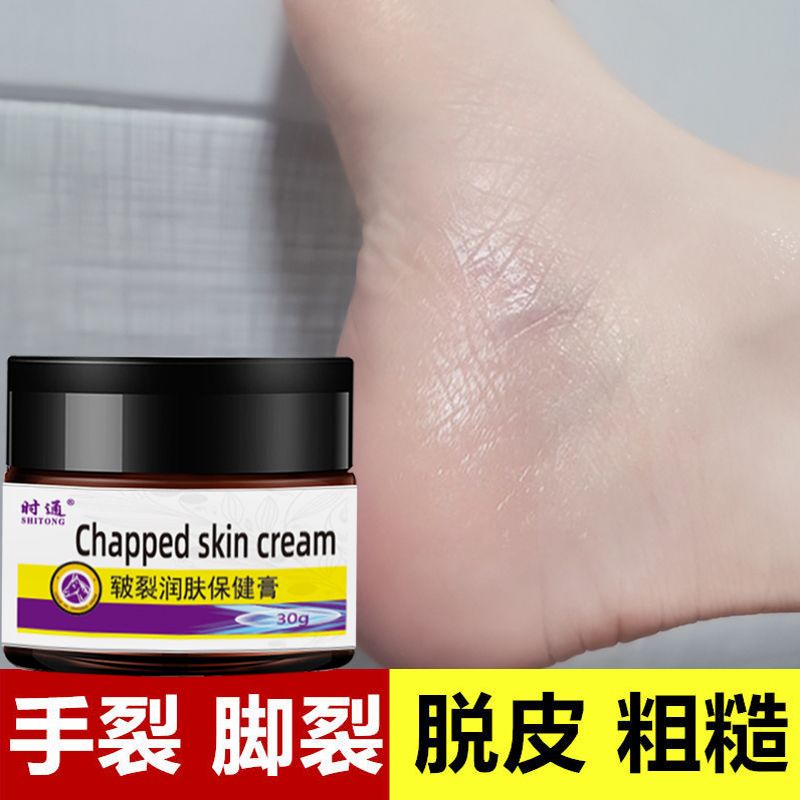 dry-and-cracked-hands-and-feet-peeling-hand-and-foot-cracking-cream