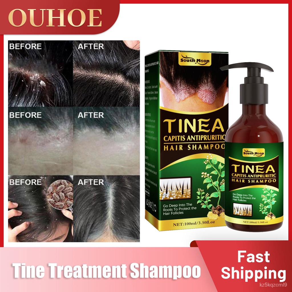 Psoriasis Shampoo Treatment Dermatitis Eczema Tinea Capitis Itching