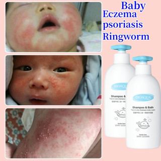 Baby 2024 antifungal shampoo