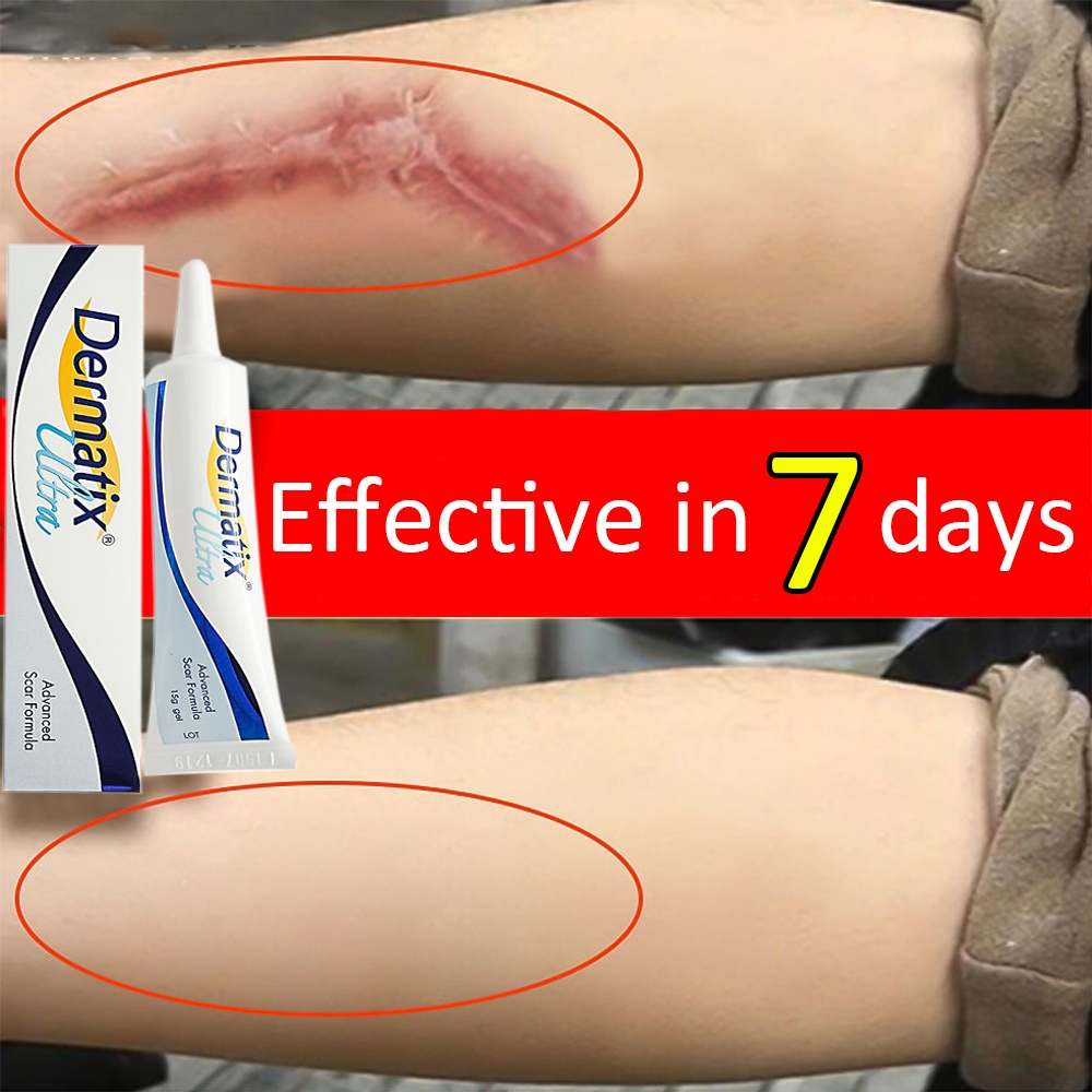 Dermatix ultra acne scar advance gel Scar Repair Cream formula 15g ...