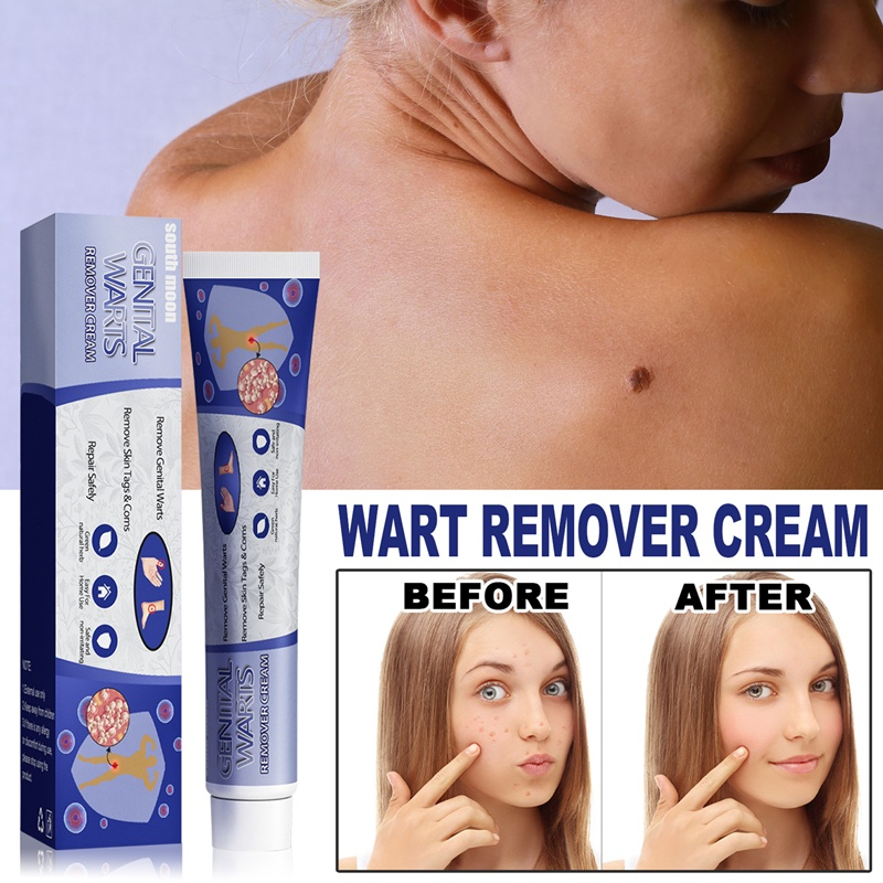 South Moon Genital Warts Remover Cream Biji Kolestrol Mole Removal Wart Cream Wart Removal