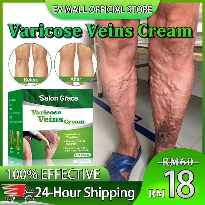 Varicose Vein Cream for Legs Improves Blood Circulation Reduces Spider Veins Tired and Heavy