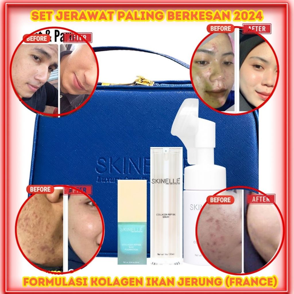 Skinelle Skincare Set for Acne and Scars Effective 2025! | Shopee Singapore