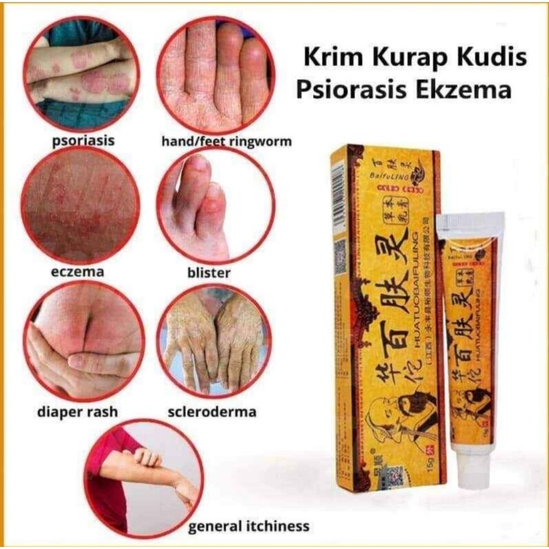 Gatal2 Eczema Psoriasis ringworm Scabies Itchy Ringworm Red Rashes ...