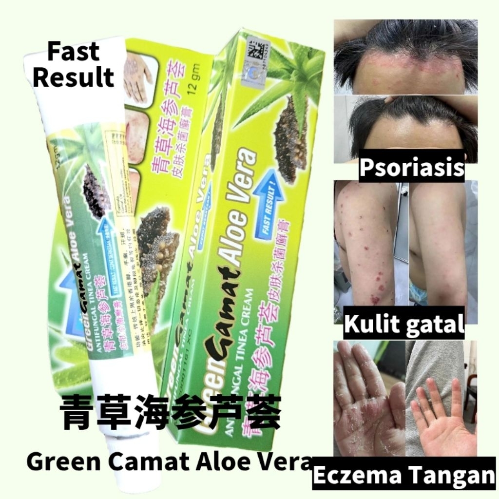 View of Aloe Vera Antifungal Cream 15g | For Athlete’s Foot, Ringworm & Tinea ...