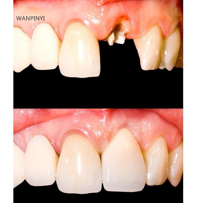 Smile temporary tooth kit dentures ready to shape flase teeth temporary ...