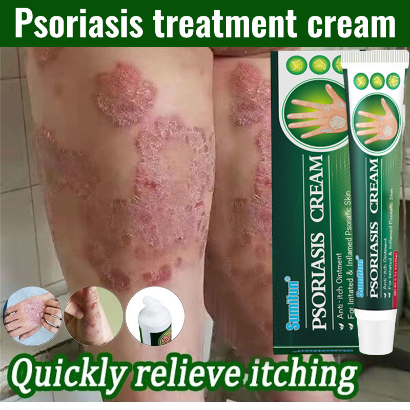 Sumifun Eczema Treatment Antibacterial Cream Anti Itch Sweat Herpes
