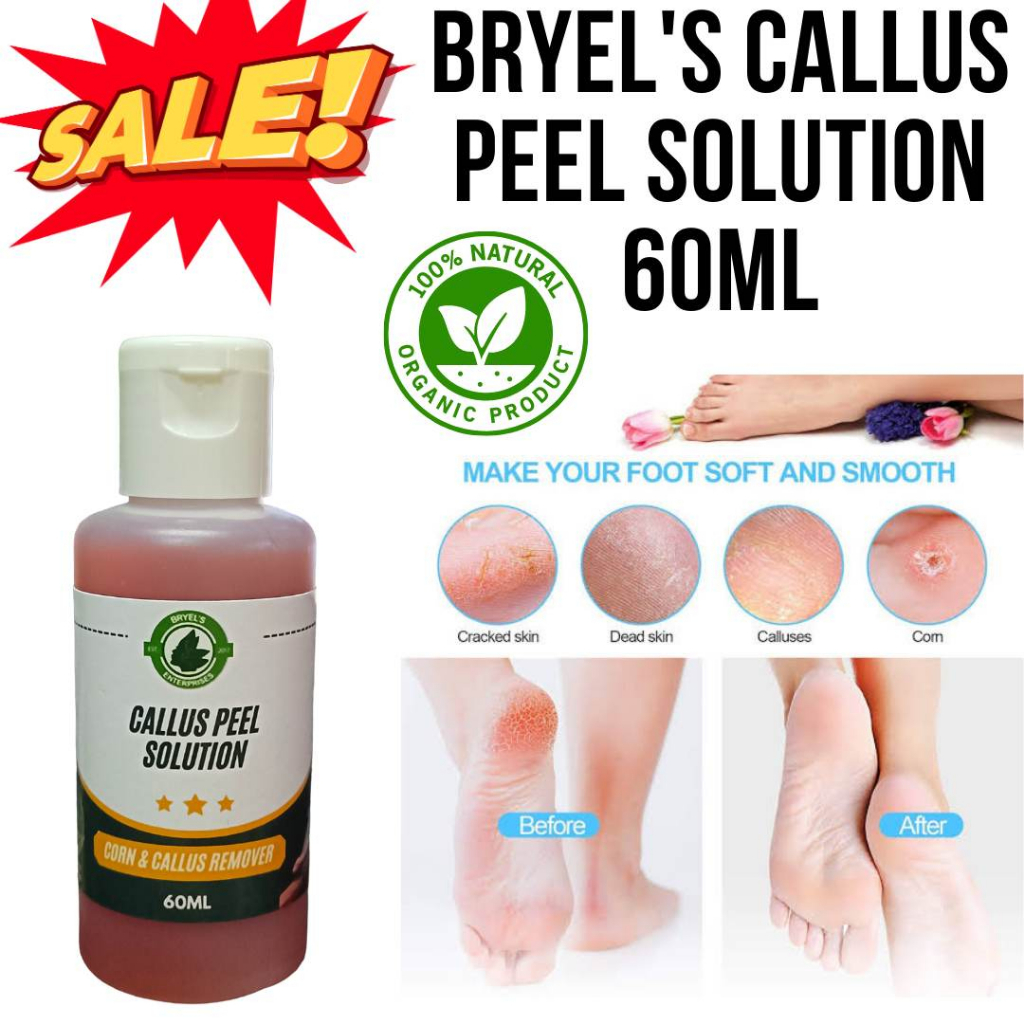 Kalyo Peel/Callus Peel Remover And Callus Pile/Pantanggal Kalyo/Callus ...