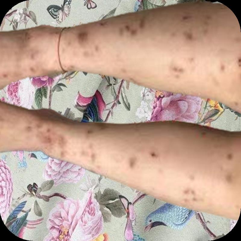 Mosquito bites Scars melanin mosquito bites Scratch melanin