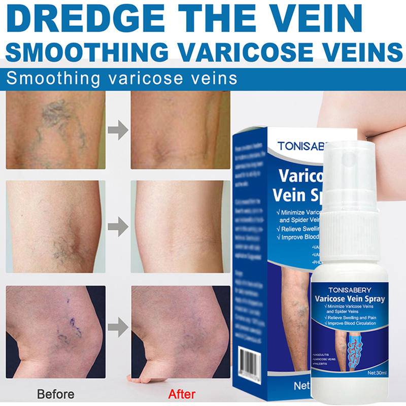 30ml Varicose Vein Spray Vasculitis Phlebitis Spider Legs Soothing