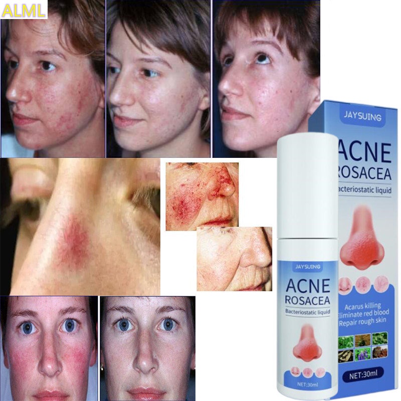 Herbal Anti Nose Mites Remove Acne Rosacea Cream Red Nose Blackhead