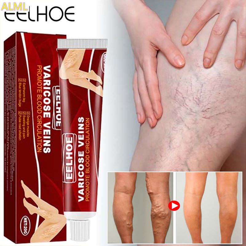 Effective Herbal Varicose Veins Relief Cream Vasculitis Phlebitis ...