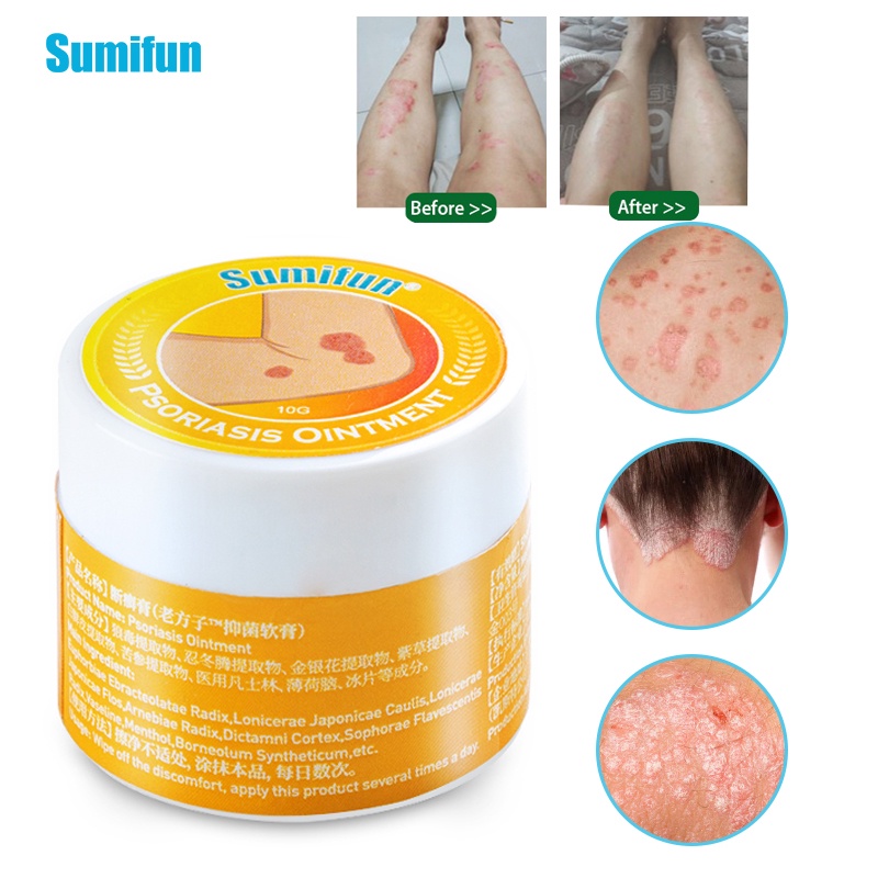 1/3pcs Skin Psoriasis Cream Dermatitis Eczematoid EczemaTreatment ...