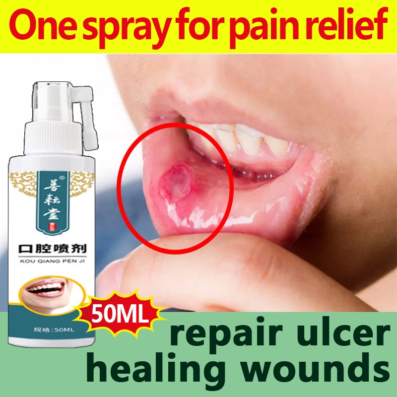 Oral Ulcer Spray Canker Sore Spray Treatment Pharyngitis Halitosis Sore Antibac Mouth Ulcers